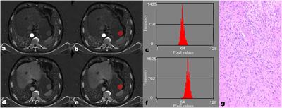 Differentiating gastric schwannoma from gastric stromal tumor (≤5 cm) by histogram analysis based on iodine-based material decomposition images: a preliminary study